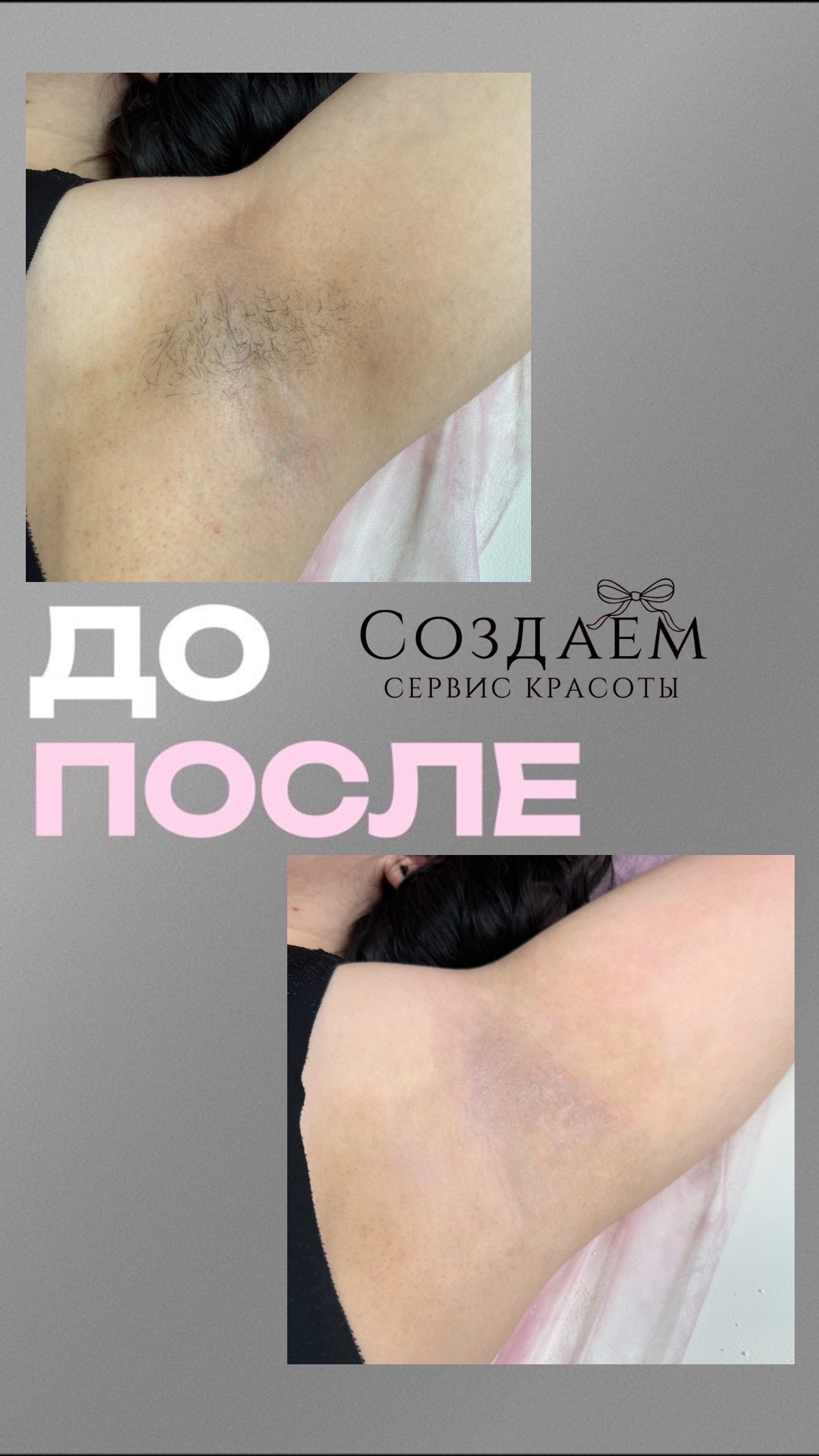 Депиляция
